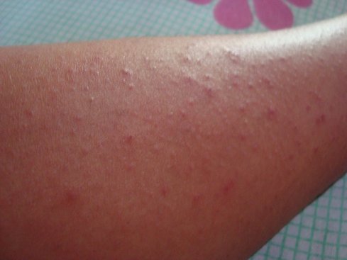 The rash started on my legs and spread across my whole body.
